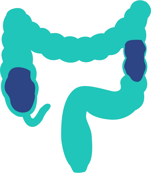 Colon Cancer
